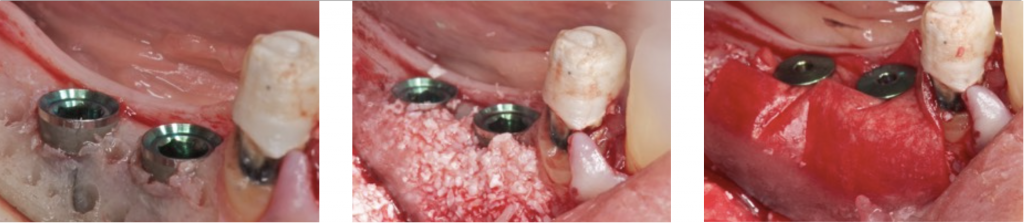 Guided bone regeneration in mandible