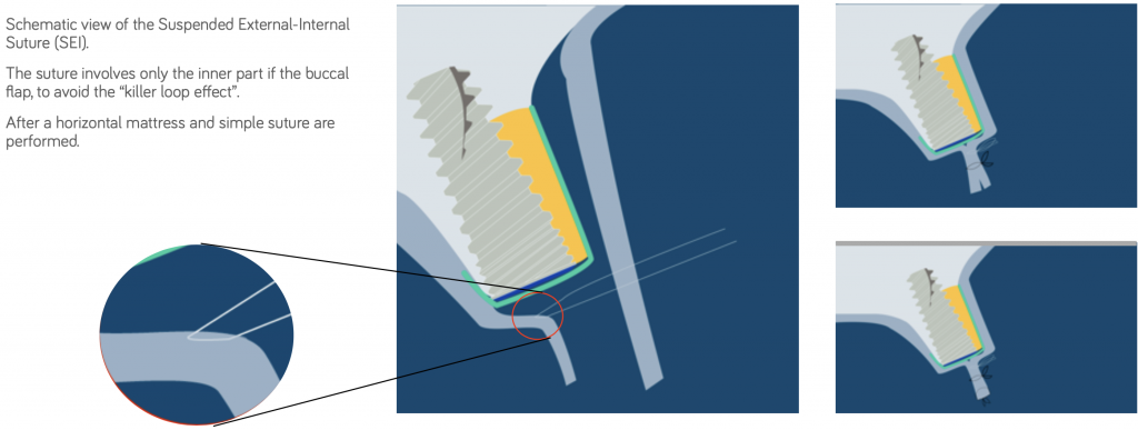 Suspended External-Internal Suture in Guided Boner Regeneration 