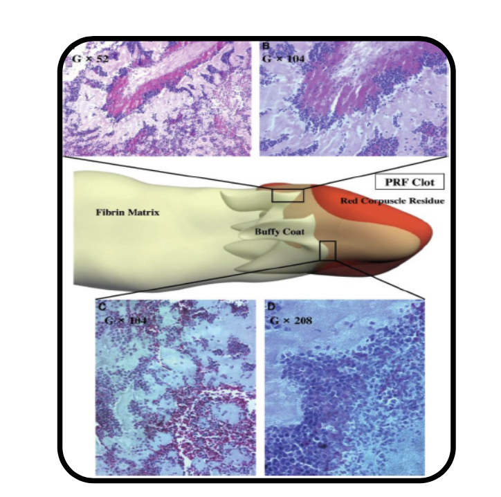 Clinical Advantages Of The Platelet Rich Fibrin In Dentistry Periospot